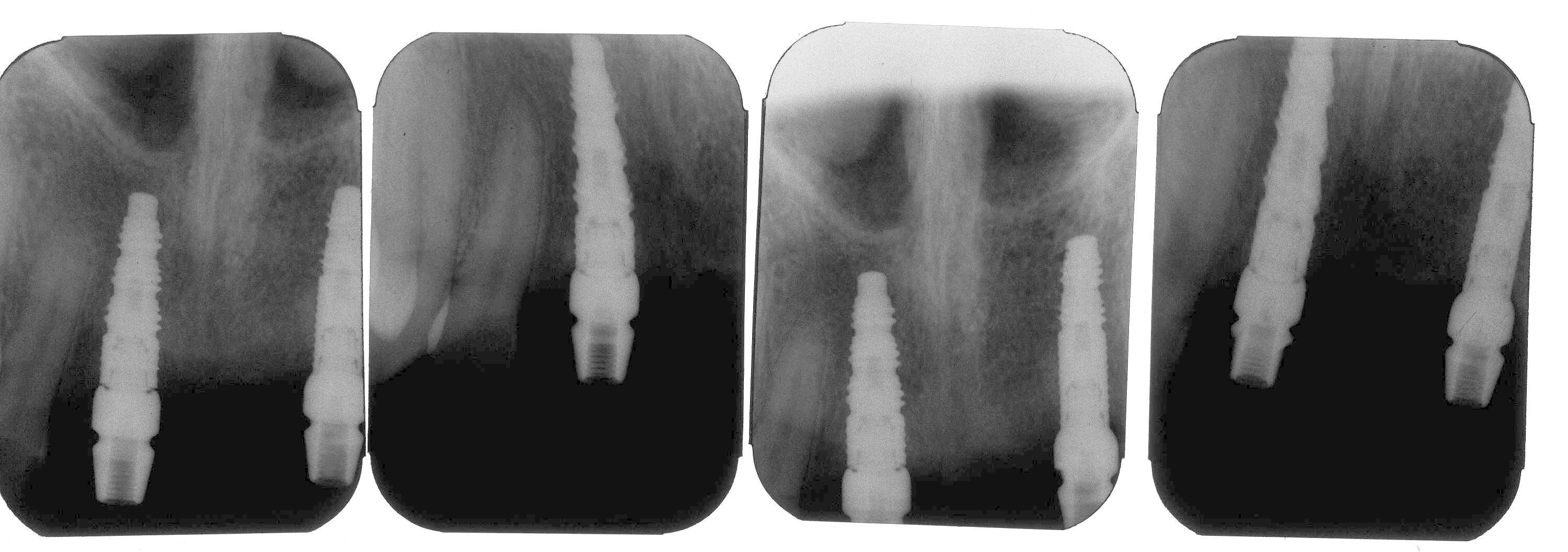 frialit стоматология